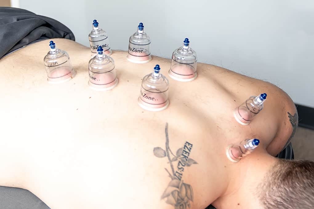 Cupping process applied along the spine