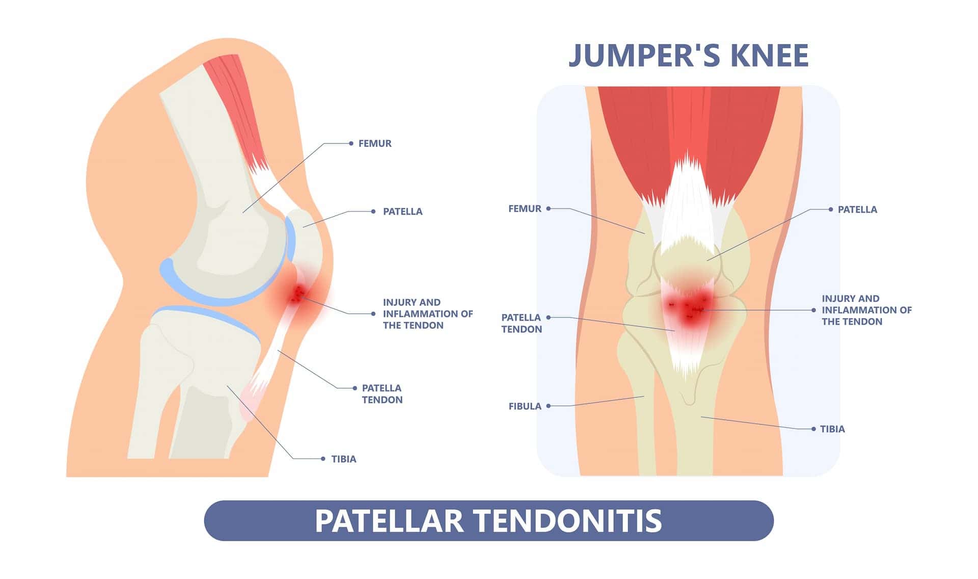Diagram of Patellar Tendonitis or Jumper's Knee.