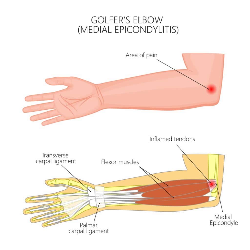 Illustration of an arm with a red dot indicating golfer's elbow, showing pain and inflamed tendons near the inner elbow.