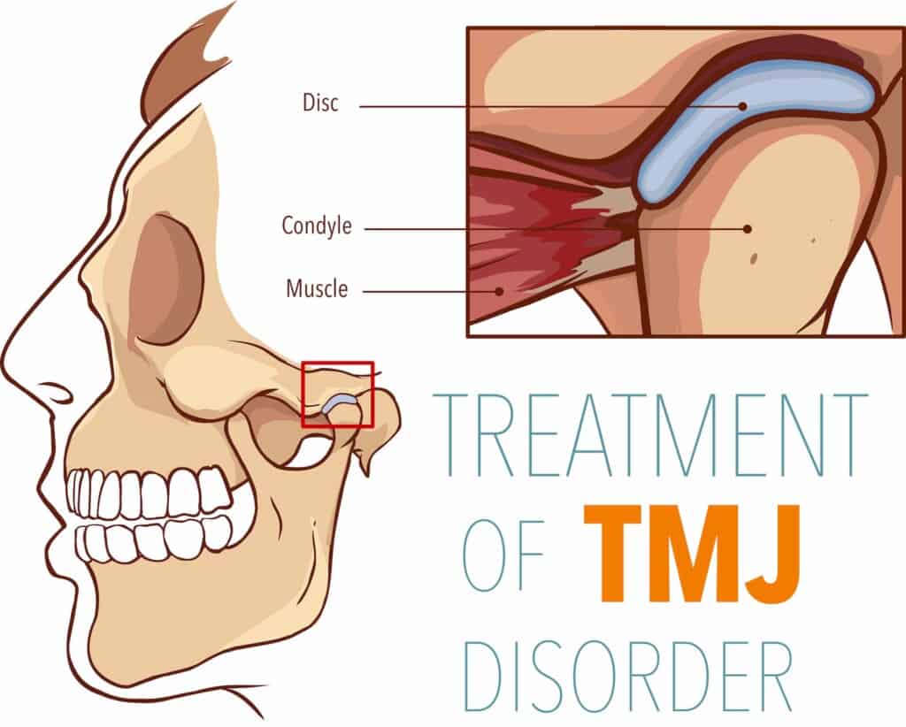 Vector illustration of treatment of TMJ disorder.