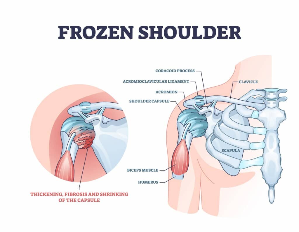 Frozen shoulder condition or adhesive capsulitis syndrome outline diagram.