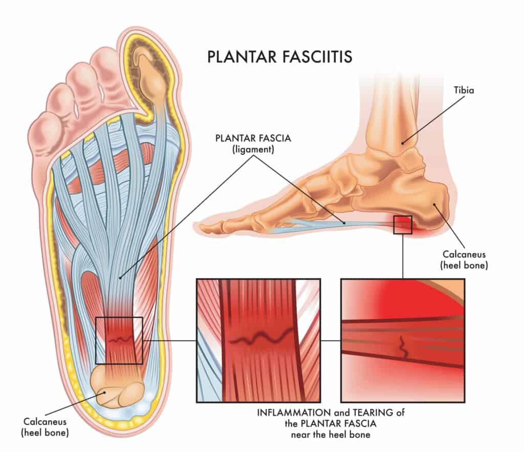 Medical illustration showing section of foot with symptoms of plantar fasciitis with two magnified details of affected points.