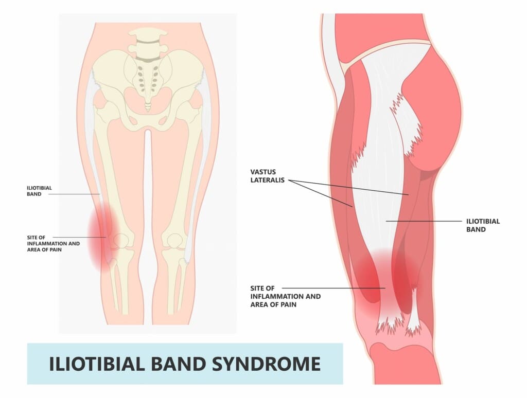 Diagram of Iliotibial Band Syndrome.