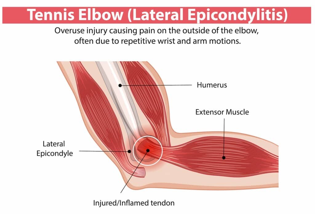 Diagram of tennis elbow injury and affected areas.