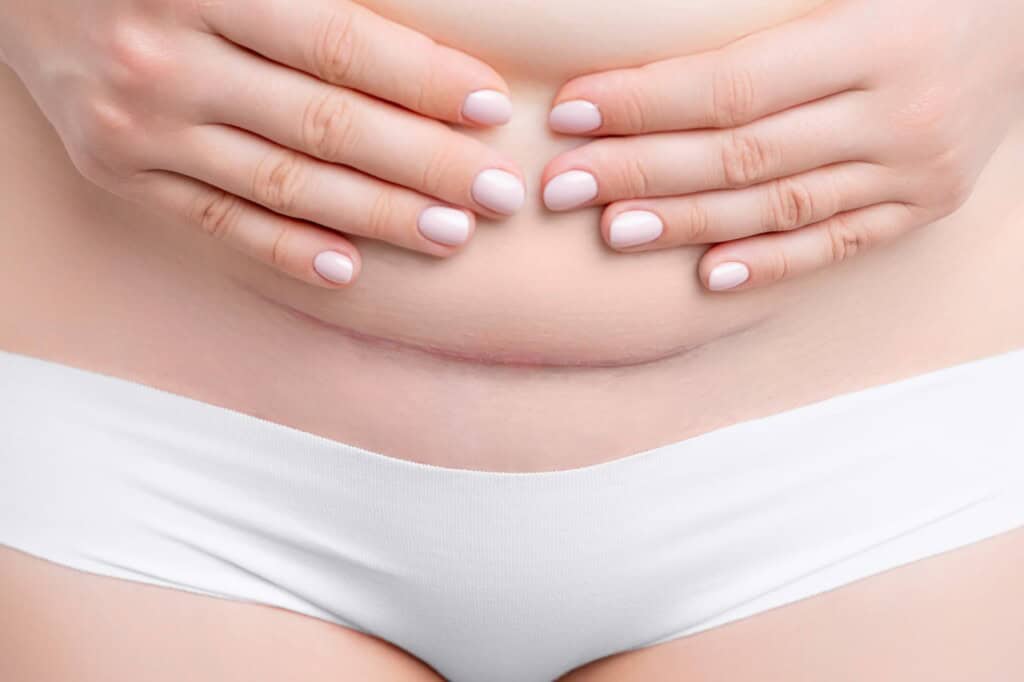 Close-up of a woman's abdomen with her hands placed above her vertical c-section scar.