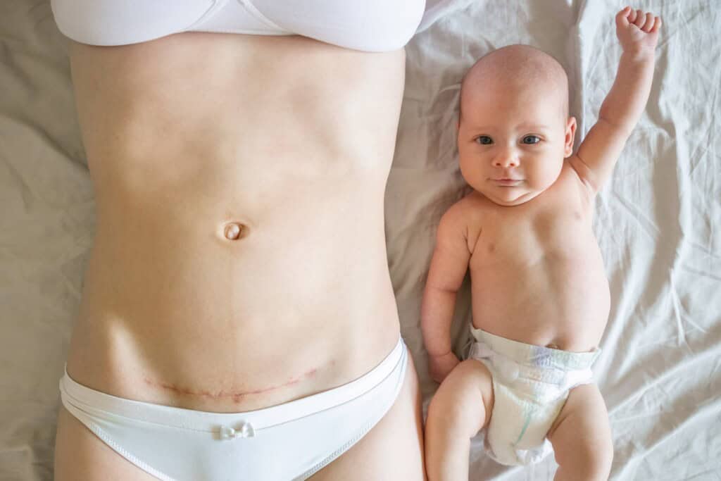 Closeup of woman's belly with a c-section scar next to her baby with baby's hand raised in the air