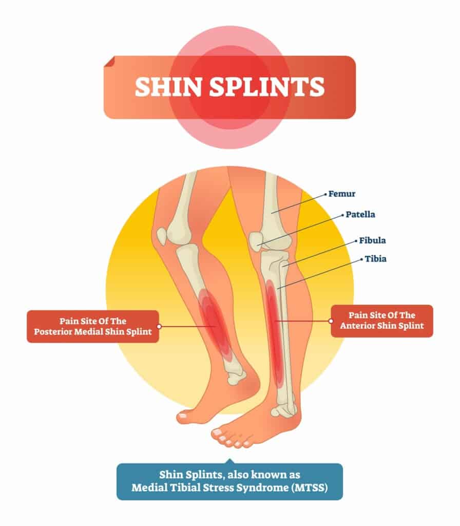 Illustration showing the various bones and pain sites associated with shin splints.