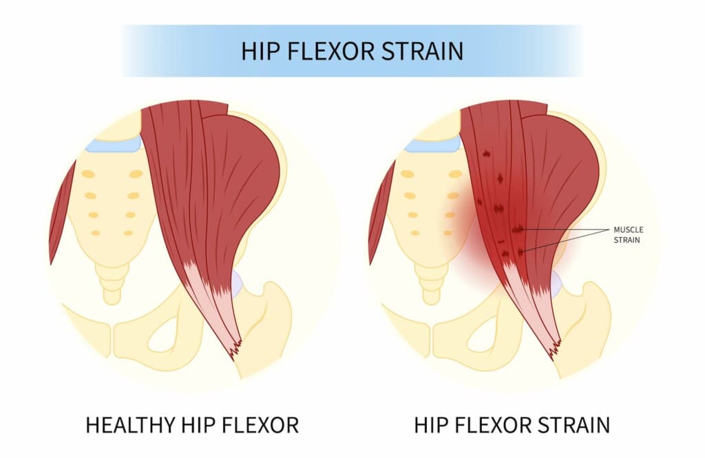 Comparison of healthy hip flexor and strained hip flexor. The healthy hip flexor is smooth, while the strained hip flexor shows muscle strain and tears.