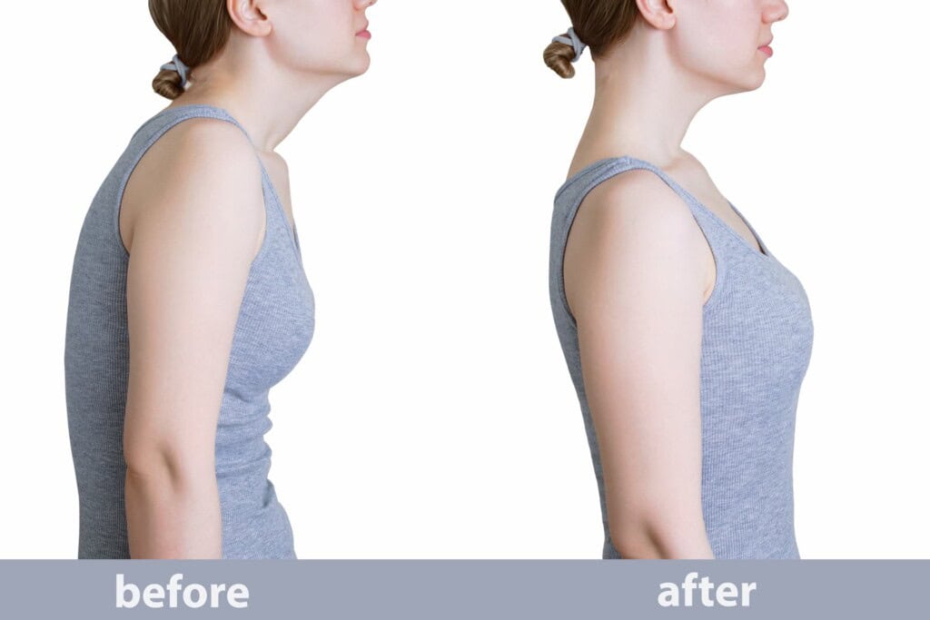 Comparison of a person with rounded shoulders and poor posture on the left, and improved posture on the right, wearing a gray tank top in both.