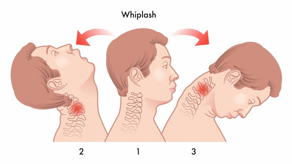 Illustration of whiplash stages: head flung backward, then forward, showing neck strain in three phases with red highlights indicating injury.