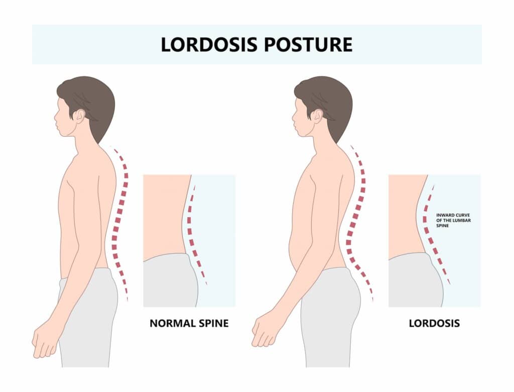 Illustration comparing a normal spine to a spine with lordosis, showing the exaggerated inward curve in the lower back.