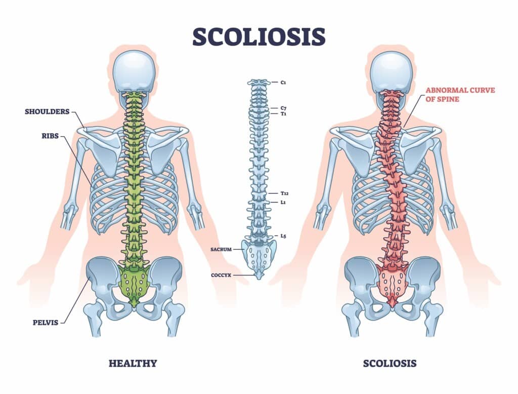 Diagram showing scoliosis by comparing a healthy spine to one with scoliosis.